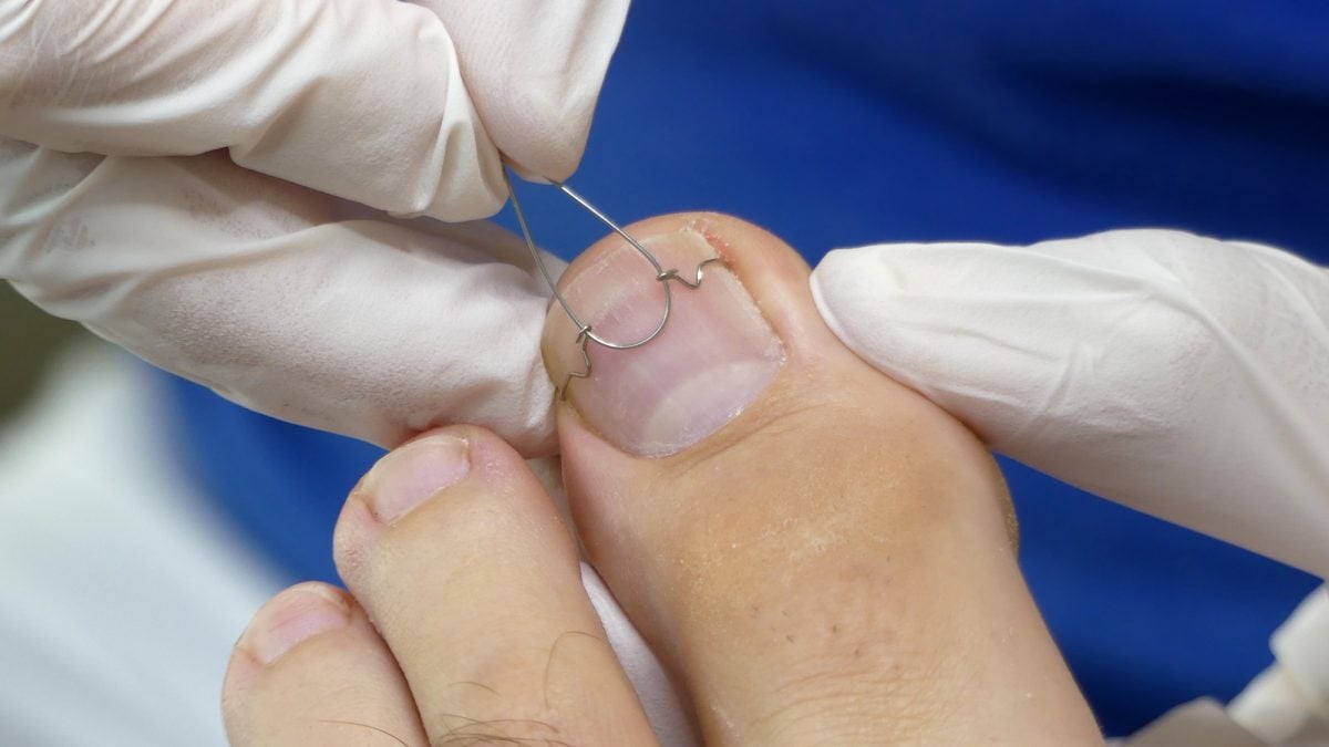 Technique d'orthonyxie